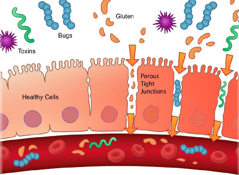 Leaky_gut Illustration showing how leaky gut allows toxins to enter the bloodstream
