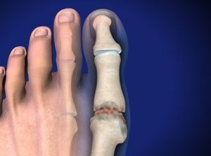 big toe pain hallux rigidus